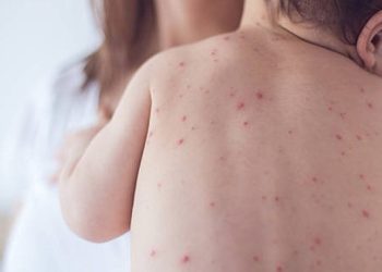 Olaylar artıyor! 1 yaş altı bebekler ağır kızamık için risk altında!