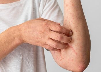 1 Ekim Dünya Ürtiker Günü: Gereksiz Besin Diyetleri Ürtikeri Tetikliyor