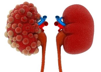 Abdi İbrahim Otsuka Medikal Yöneticiliği: Polistik Böbrek Hastalığının Seyrini Değiştirmek Mümkün