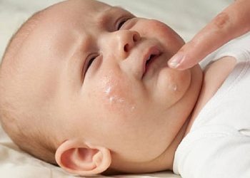 Bugün 14 Eylül Dünya Atopik Egzema Günü:Egzama Çocuklarda Daha Sık Görülüyor